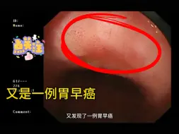 又是一例胃早癌！这是我一位朋友的妈妈，在我早癌概念的不断灌输下，她拉着她妈妈来做胃镜了，在胃角处见一处IIb病变，考虑早癌，待ESD病理结果