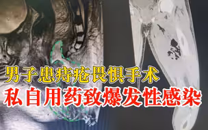 男子患痔疮私自用药致爆发性感染，医生：他听朋友介绍害怕手术