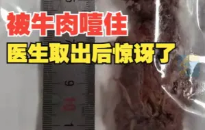 男子聚餐吃一块牛肉被噎到全身出现青紫 医生取出时惊讶了：足足有20克