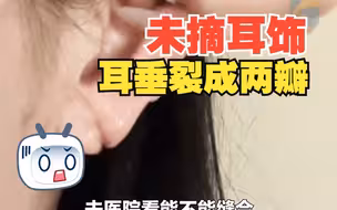 女子晚上睡觉未摘耳饰 结果耳垂裂成两瓣 准备去医院缝合