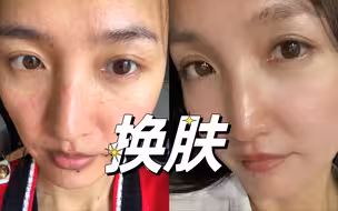换肤！5年皮肤抗敏抗炎，这些方法帮我恢复