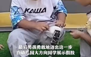 萌娃在幼儿园大方展示假肢，网友：认真生活的小钢铁