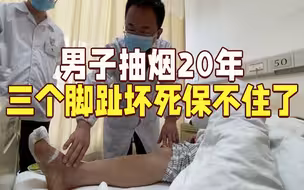 男子抽烟20年致血管堵塞 三个脚趾坏死保不住了