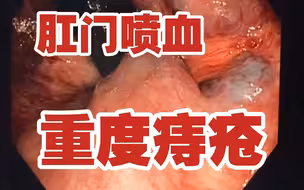 十人九痔，重度“痔疮”长什么样子？！