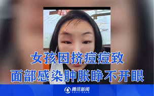 不要“看不起”任何一个痘痘！女子因挤痘痘导致面部感染：输了7天液才好