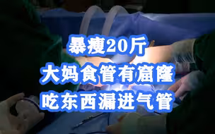 8个月瘦20斤！大妈食管有窟窿吃东西漏进气管，上海医生用微创手术根治