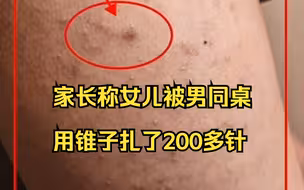 家长称女儿被男同桌用锥子扎了200多针,“还让女儿吃纸，喝化学液体”