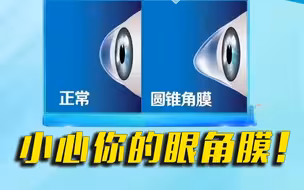 注意！经常揉眼睛或导致眼角膜破裂