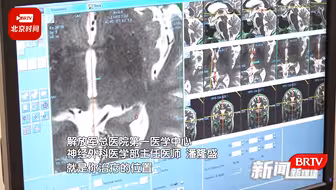 牛！患者福音：解放军总医院用磁波刀治疗帕金森病