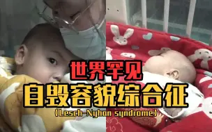 八个月大双胞胎男婴 患上世界罕见的自毁容貌综合征