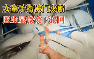 女童手指被门夹断医生显微镜下接回：血管神经细小，目前恢复良好