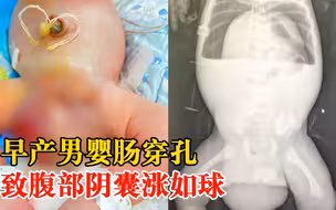 早产男婴肠穿孔致腹部阴囊涨如球：胎粪进入腹腔引起全腹性腹膜炎