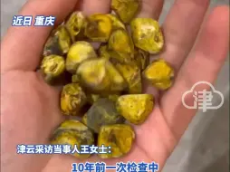 重庆29岁女子取24颗胆结石 收藏后盘着玩：留着当纪念品。有人盗走图片售卖，女子表示都是假的。