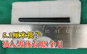 5厘米断筷插入男孩右眼残留1个月：已插入颅内，医生手术取出