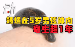 活体蚂蟥寄生5岁男孩体内超一年：蚂蟥如何进入人体？