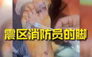 心疼！震区消防员脚磨破消毒痛得大叫