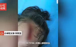 江苏5岁女童遭大型犬咬伤头部面部  当地回应：伤人犬只已被处理，后续事宜相关部门正在调查
