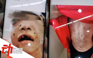 黑龙江4岁女童疑遭继母殴打，当地：人已关押，检察院提前介入