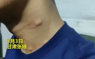 消防员参加野外驻训任务，在参加点名时被咬的全身是包，他却纹丝未动！