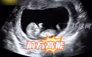 B超视角下看准妈妈怀孕期间大笑，小宝宝：脑瓜子嗡嗡的