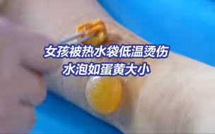 一觉醒来皮肤被热水袋烫硬了！低温烫伤，不觉烫但伤害大！