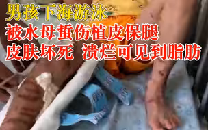 男孩下海游泳被水母蜇伤植皮保腿：皮肤坏死，溃烂可见到脂肪