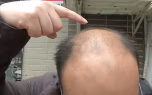 花一万六生发无效果 男子按合同索赔却被“踢皮球”