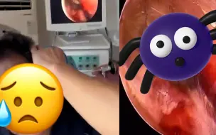 现场：男子树下乘凉时蜘蛛钻进耳朵结网安窝 医生：第一次见