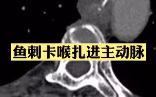 危险！女子硬吞饭团把鱼刺扎进主动脉