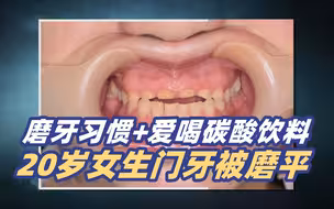 可怕！20岁女生爱磨牙喝碳酸饮料致门牙磨平