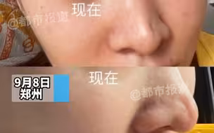 都市报道【24岁女孩3次隆鼻致“毁容”？鼻子发炎流血，术后留下大坑！美容院：自己签的字，手术有风险！】