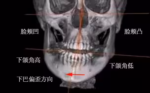 很多人不了解自己下颌骨是如何偏歪的一种形式，如图对比