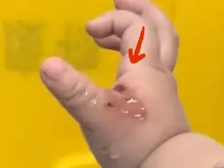 粗心爸妈带1岁半女宝放冷烟花，宝宝好奇直接伸手去撸烟花棒，拇指虎口被烫两个“洞”。