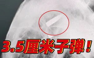一颗子弹在老战士肩上藏了74年！