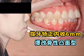 没do、没垫下巴，只是做了牙齿矫正！