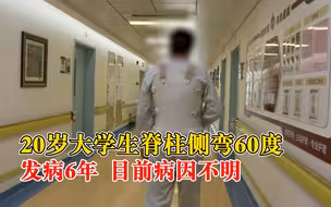 20岁大学生脊柱侧弯60度：发病6年，目前病因不明