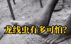 毒害非洲的龙线虫太恐怖！拔虫要忍受数十小时的折磨