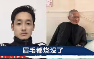 38岁辅警救火时面部被烧伤，还和妻子开玩笑：有疤痕的男人更帅