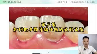 第三集：如何把多颗牙做的又好又快