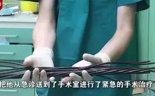 工人作业不慎被14根钢筋戳穿身体 多科室医生联手抢救两小时取出