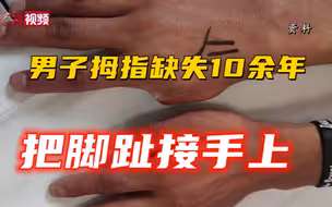 四川小伙拇指缺失  医生把脚趾接手上